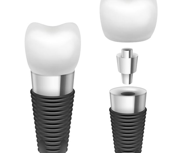 Vector metal disassembled tooth implant side view isolated on white background