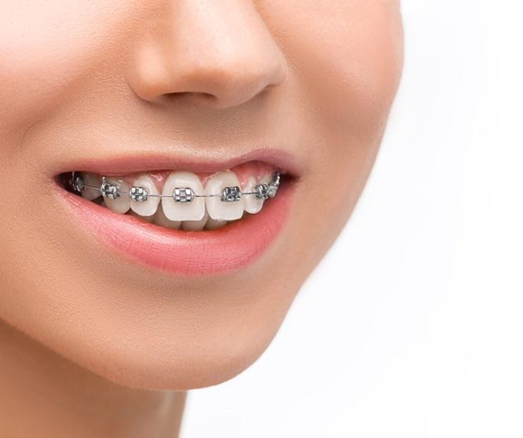 Beautiful young woman with teeth braces on gray