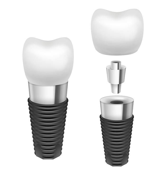 Vector metal disassembled tooth implant side view isolated on white background